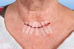 Nobamed hechtstrips Rudastrip zwaluwstaartjes hechmateriaal Arvem Hillegom