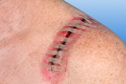 Nobamed hechtstrips Rudanath zwaluwstaartjes hechmateriaal Arvem Hillegom