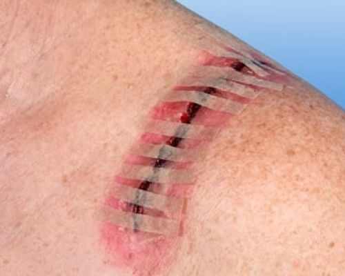 Nobamed hechtstrips Rudanath zwaluwstaartjes hechmateriaal Arvem Hillegom